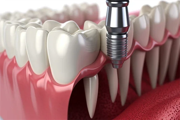 广州齐美口腔门诊部现推出牙周治疗优惠，原价800元起现仅需600元起，抓住难得机会，赶快体验我们的专業服务！