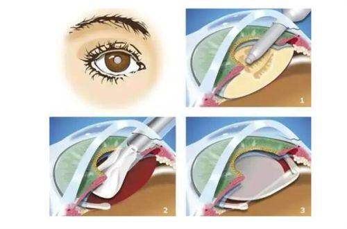 福鼎市医院眼科详细的预约挂号方式及流程