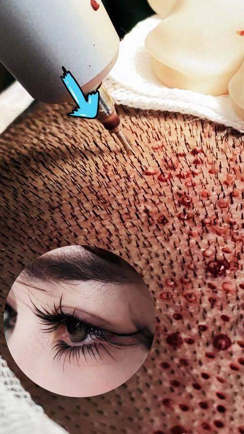 成都丝缘植发医生团队实力强大及骨干医生简介