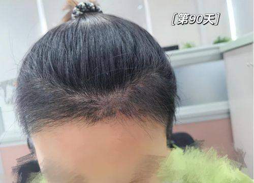 成都丝缘植发特色项目及技术优势