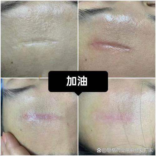 成都丝缘植发收费价格表/收费标准