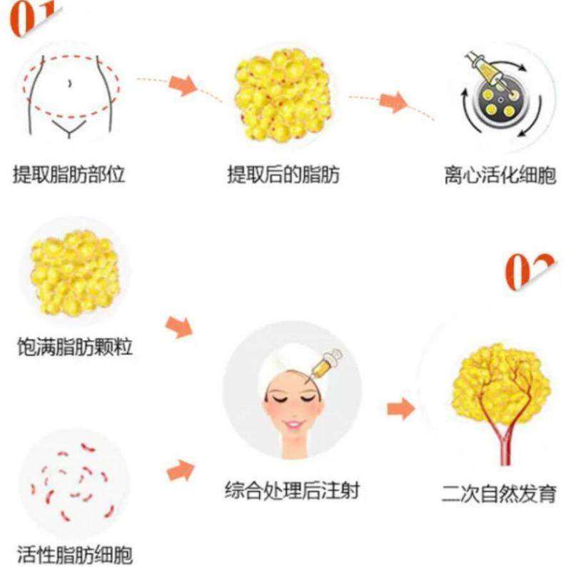 酷塑冷冻减脂：原理与优势解析