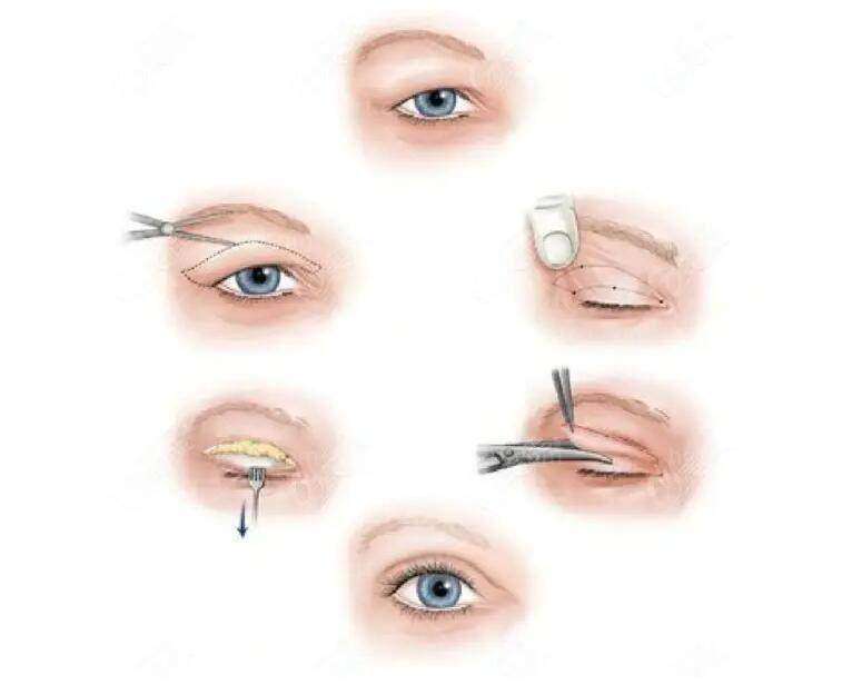飞顿OPUS超离子颈部护理套餐的治疗过程与体验