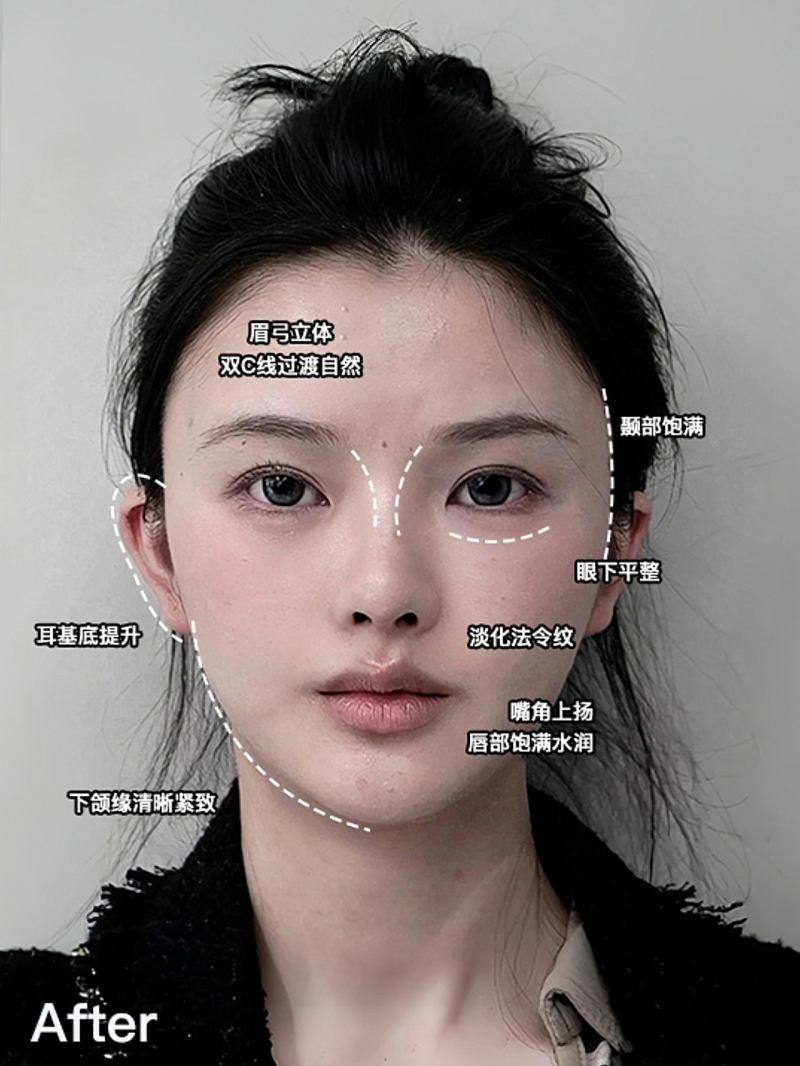 西安艺星徐智慧院长亲诊｜玻尿酸改菱形脸，半小时获自然高级还留个人风格