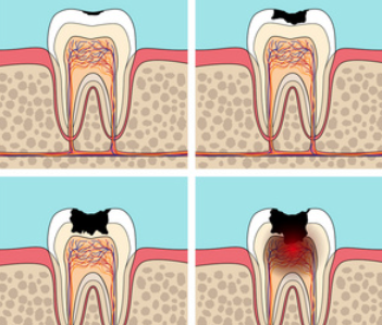 人生第一次洗牙太舒心！牙结石少十分钟搞定，医生细心环境好，下次还来