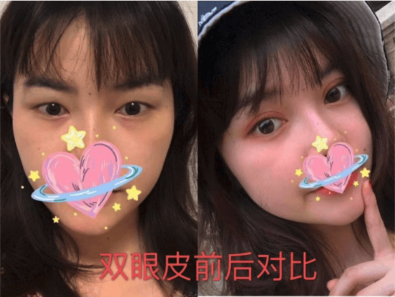 深圳阳光整形医院第七代黄金超光子全模式真人实例