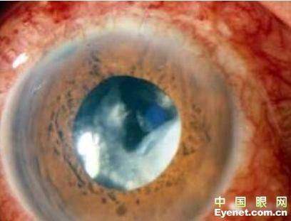 南京大学医学校附属金陵医院眼科真人口碑评价怎么样？