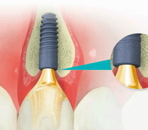 种植牙术后维护要点