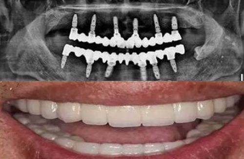 种植牙与传统义齿修复对比