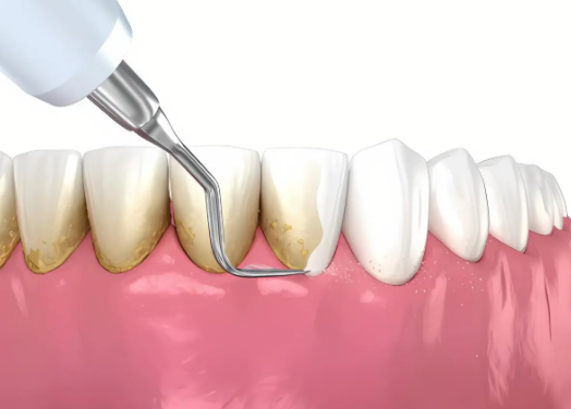 国产百康特种植牙3980元起，性价比高适合预算有限者，稳定耐用提升生活质量