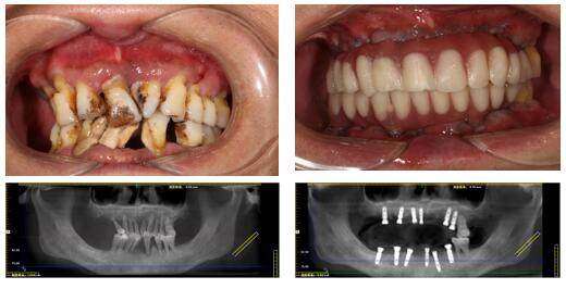 纠结许久选南京美奥拔智齿，全程无痛手法专业，恢复好吃饭不受影响超省心