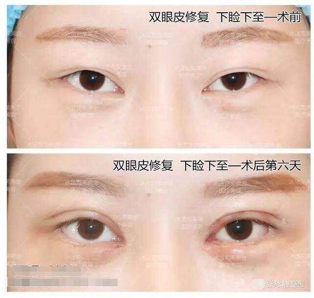 北京客来美舍江会芳医生隆胸技术特色