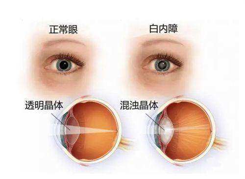 中南大学湘雅医院眼科收费价格表/收费标准